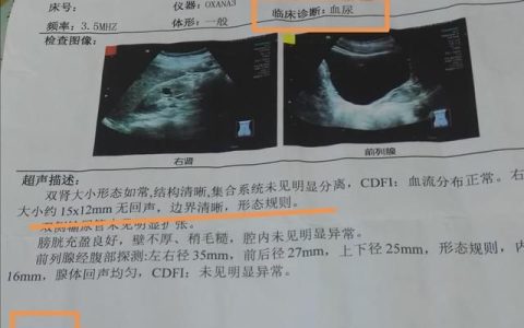 做增强ct,发现右肾小囊肿,会变成癌症吗