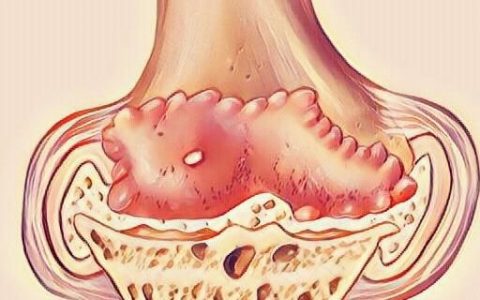 治疗骨刺最好的方法(膝盖骨刺的治疗方法)