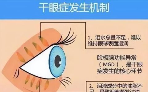 眼睛干涩使用网红眼药水,眼睛干结膜炎用什么眼药水