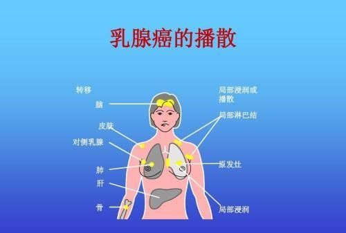 乳腺癌术后要不要吃中药(乳腺癌术后手臂肿中药)图6