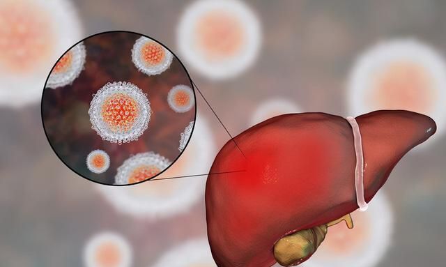 诱发因素、传播途径、治疗方法…关于丙肝的这些问题，一一解答