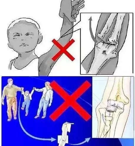 宝宝关节容易脱臼怎么办(髋关节脱臼怎么治疗)图4