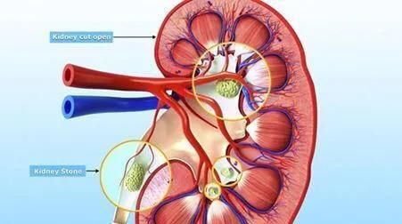 如何通过调整饮食排出肾结石图1